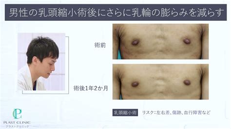 チクニー 肥大化|男性の乳頭肥大症